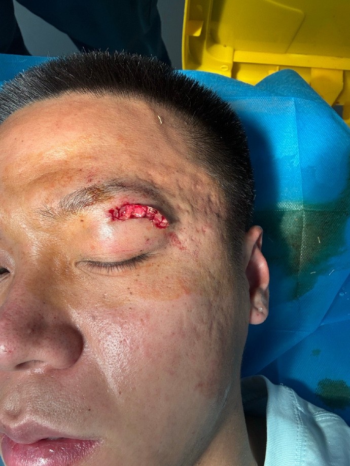  踢球致眼伤是否应得红牌引发讨论